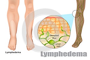 Lymphedema, also known as lymphoedema photo