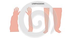 Lymphedema of arm and leg photo