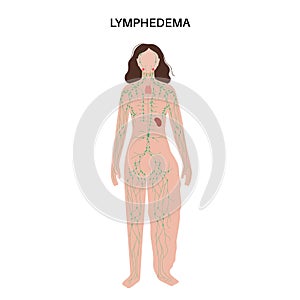 Lymphedema leg swelling photo