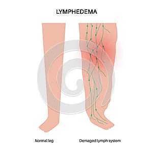Lymphedema leg swelling photo