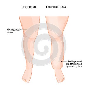 Lymphedema and Lipoedema. Comparison and difference. Overweight problem
