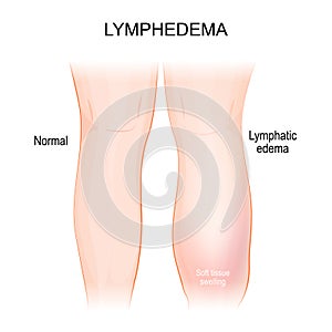 Lymphedema. lymphoedema. Healthy leg, and lymphatic edema