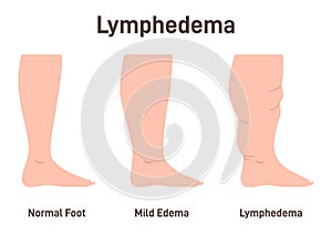 Lymphedema stages. Lymphatic system dysfunction disease. Swollen legs,