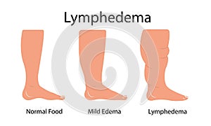 Lymphedema stages