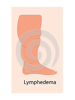 Lymphedema stages