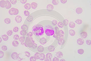 Lymphocyte&band form neutrophil