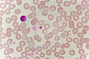 Lymphocyte cell in blood smear