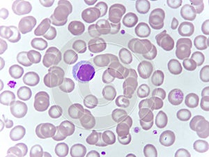 Lymphocyte cell in blood smear