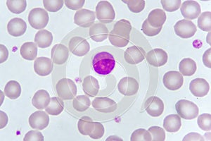 Lymphocyte cells in blood smear