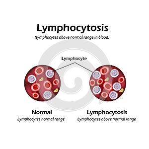 Lymphocytes above the normal range in the blood. Lymphocytosis. Vector illustration