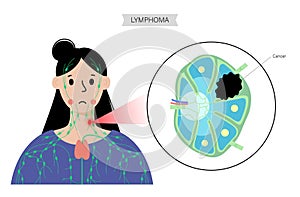 Lymphoma cancer concept