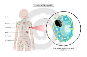 Lymphoma cancer concept