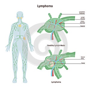 Lymphoma. Healthy lymph node structure and lymph node affected