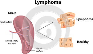 Lymphoma