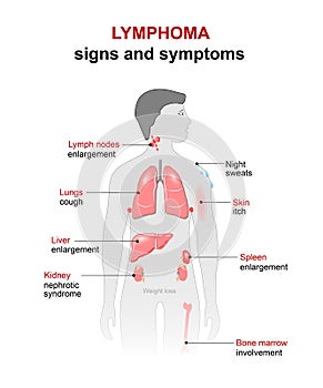 Lymphoma. Signs and symptoms