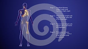 Lymphoma staging and prognosis medical animation