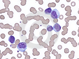 Lymphoplasmacytic lymphoma in peripheral blood.