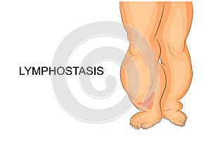 Lymphostasis. lymph edema of the feet
