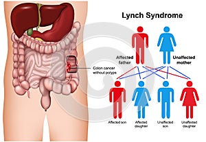 Lynch syndrome disease 3d medical  illustration on white background