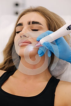 Macro close up detail of laser plasma pen removing facial wart on young woman. Noninvasive cosmetic treatment photo
