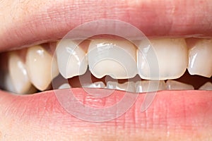 Macro close-up of human teeth. Shows the chipped tooth. The effect of the cutter's tooth from biting the seeds shell and