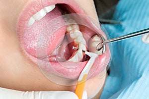 Macro close up of interdental cleaning on human teeth.