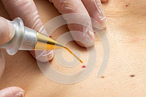 Macro close up of laser plasma pen removing cherry angioma on human skin