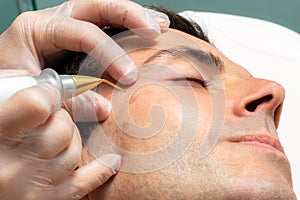 Macro close up of laser plasma pen removing facial melanoma on middle aged man. photo