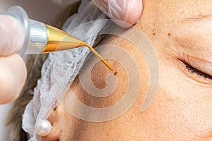 Macro close up of laser plasma pen removing facial wart on middle aged woman