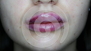 Macro close-up of swollen lips after injections of hyaluron, lip augmentation