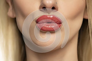 Macro close-up of swollen lips after injections of hyaluron, lips augmentation on a white background