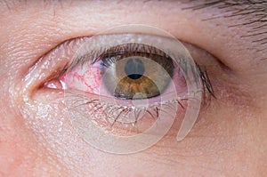 Macro of conjunctivitis red eye