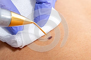 Macro close up of laser plasma pen removing wart on human skin