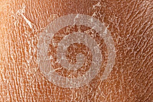 Macro of dry peeling skin