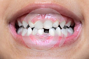 Macro of the mouth of a little girl who has lost a tooth