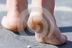 Macro photo of cracked heels. Male back view.