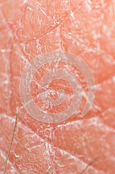 Macro photo of dry human skin after frequent washing hands with soap