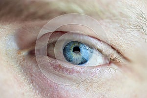 Macro photo of a male eye with eyeball disease