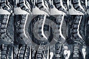 Macro photo of MRI of lumbar spine with osteochondrosis, age-related changes in discs of vertebrae and pinched nerves photo