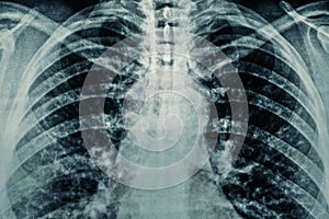 Macro photo of Radiological chest x-ray film with film grain. Asthma, COVID-19, coronavirus or pneumonia diagnostic