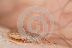 Macro photo of a skin wart, papilloma virus infection