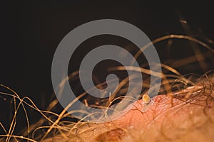 Macro photo of a tick stuck in the skin of a male person. Tick hiding between hair on a leg. Oil is being used to sedate and