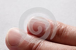Macro photo of vertical ridges in fingernails