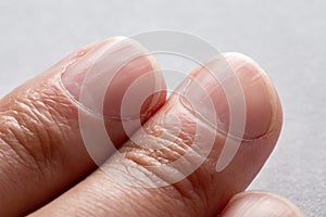 Macro photo of vertical ridges in fingernails