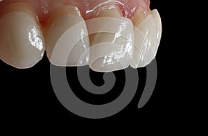Dental ceramic veneers on the black background