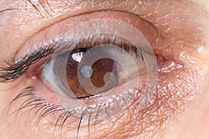 Macro photos of the human eye - cataract clouding of the lens, deterioration of vision. Treatment, surgery and ophthalmology