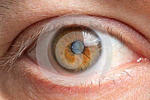 Macro photos of the human eye - cataract clouding of the lens, deterioration of vision. Treatment, surgery and ophthalmology