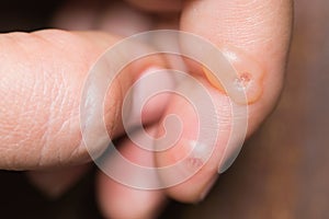 Macro shoot of warts on female finger