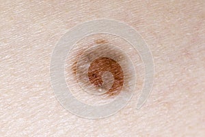 Macro shot of a big skin mole