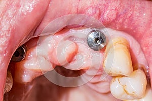 A macro shot of dental implant in the mouth of a patient with ad